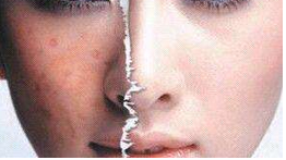 怎么去掉痤疮印