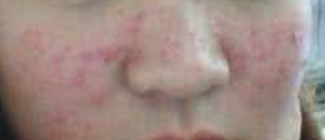 座疮印怎么形成的