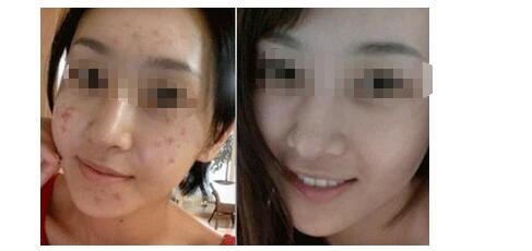 去痘印效果图